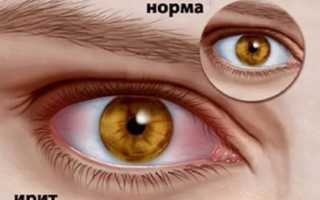 Светобоязнь глаз – причины и лечение проявления у детей и взрослых: важные аспекты