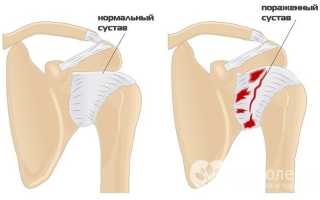 Остеоартроз плечевого сустава: особенности заболевания