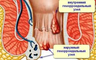Лекарства от геморроя: недорогие и эффективные средства для лечения