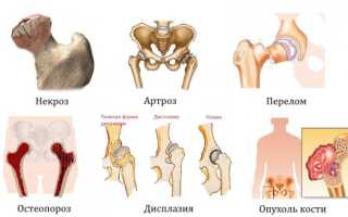 Кисты вертлужной впадины и головки бедренной кости: лечение и операции