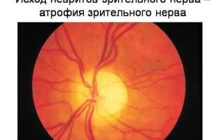 Ретробульбарный неврит зрительного нерва: причины и симптомы заболевания