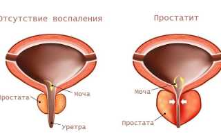 Какие антибиотики применяют для лечения простатита у мужчин