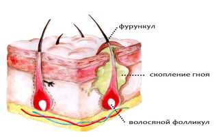 Как быстро вылечить фурункул в домашних условиях?