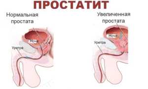 Как делать массаж простатита в домашних условиях правильно и эффективно