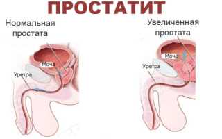 Как делать массаж простатита в домашних условиях правильно и эффективно
