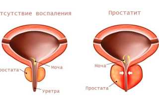 Лечебная гимнастика при простатите для улучшения здоровья