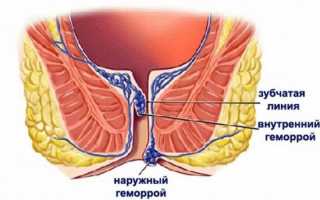 Лечение внутреннего геморроя свечами: эффективные методы и советы