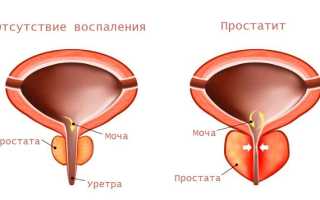Препарат Детралекс: инструкция по применению при простатите и его особенности