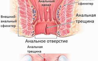 Заболевания прямой кишки и заднего прохода: список болезней ануса и их симптомы