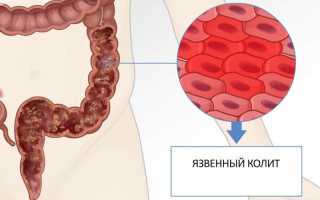 Лечение катарального колита кишечника: методы и рекомендации
