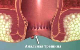 Что такое анальные трещины и причины их возникновения: важные аспекты здоровья