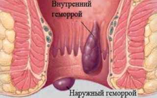 Наружный геморрой: причины, признаки и методы лечения внешнего геморроя у пациентов.