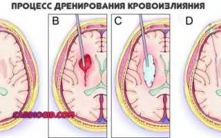 Инсульт мозжечка головного мозга: симптоматика, тактика терапии и последствия