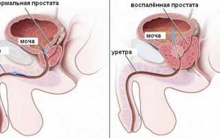 Как узнать, что начался простатит: советы и рекомендации