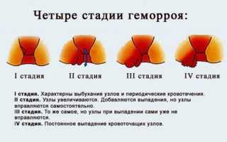 Последствия геморроя — чем он опасен если не лечить, и как избежать