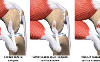 Симптомы и терапия повреждения связки надколенника