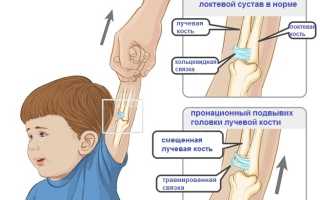 Подвывих локтевого сустава у ребенка: лечение, симптомы и последствия