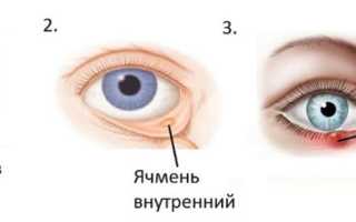 Ячмень внутри нижнего века: симптомы и лечение, советы врача