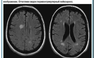 Лейкоареоз: что это, причины, признаки, лечение, формы, прогноз