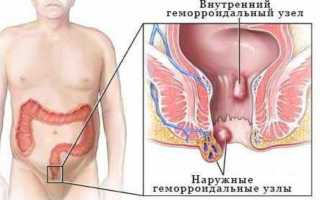 Как лечить геморрой холодом: инструкция и отзывы от специалистов