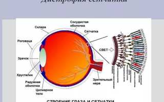 Дистрофия сетчатки глаза: симптомы и профилактика лечения для здоровья глаз