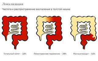Что такое атонический колит — симптомы и лечение, полезная информация