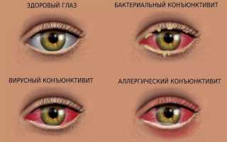 Как отличить вирусный конъюнктивит от бактериального: симптомы и лечение у взрослых, советы специалистов