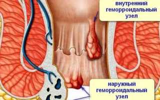 Гимнастика при геморрое: упражнения для лечения и профилактики