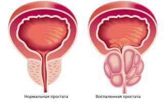 Травы от простатита: самые эффективные рецепты для лечения простатита и их применение