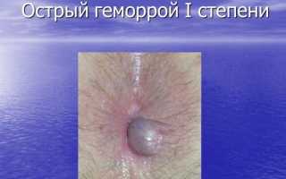 Чем лучше лечить геморрой: свечи или мазь для эффективного лечения
