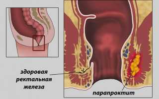 Как лечить парапроктит после операции правильно и эффективно