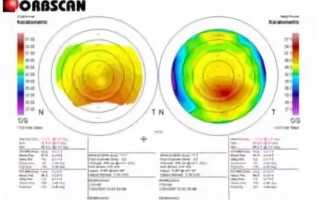 Кератотопограмма – что такое компьютерная кератотопография роговицы глаза и её преимущества
