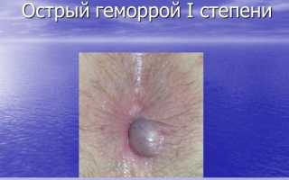 Лечение хронического геморроя: эффективные методы и рекомендации