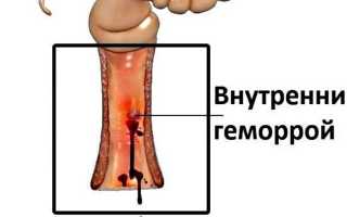 Чем лечить внутренний геморрой: советы и рекомендации