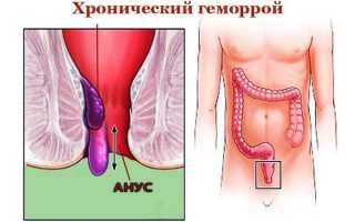 Лечение геморроя лавровым листом: рецепт и отзывы о методе