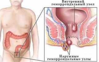 Как и чем лечить геморрой у женщин в домашних условиях: советы и рекомендации