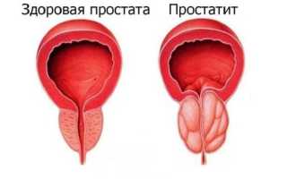 Что такое простатит: его причины, симптомы и лечение у мужчин