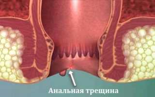 Причины чувства распирания в заднем проходе и как от него избавиться: советы и рекомендации