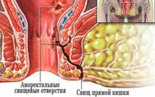 Что такое свищ прямой кишки, как он выглядит и как его лечить: полезная информация
