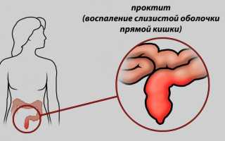 Чем лечить прямую кишку в домашних условиях: советы и рекомендации