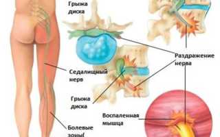 Какие симптомы возникают, когда человек сорвал спину