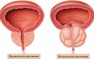 Лечение простатита: список эффективных таблеток и препаратов для здоровья