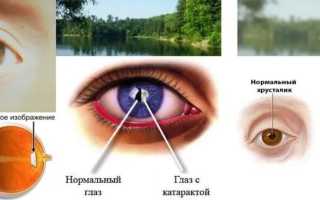 Борец с катарактой: характеристика капель для глаз Квинакс и их применение