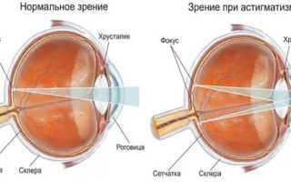 Астигматизм – что это такое и как лечить, причины и симптомы