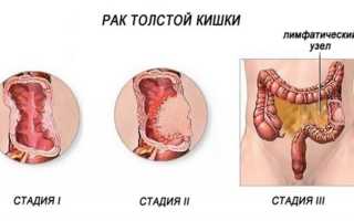 Что такое рак толстой кишки: его причины и симптомы, важные факты