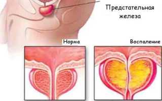 Имбирь при простатите: рецепт для лечения простатита и отзывы о его эффективности
