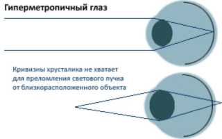 Гиперметропия слабой степени обоих глаз у детей: причины и лечение