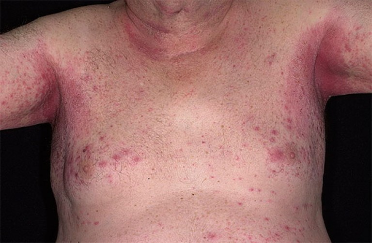 стадии и локализация опрелостей