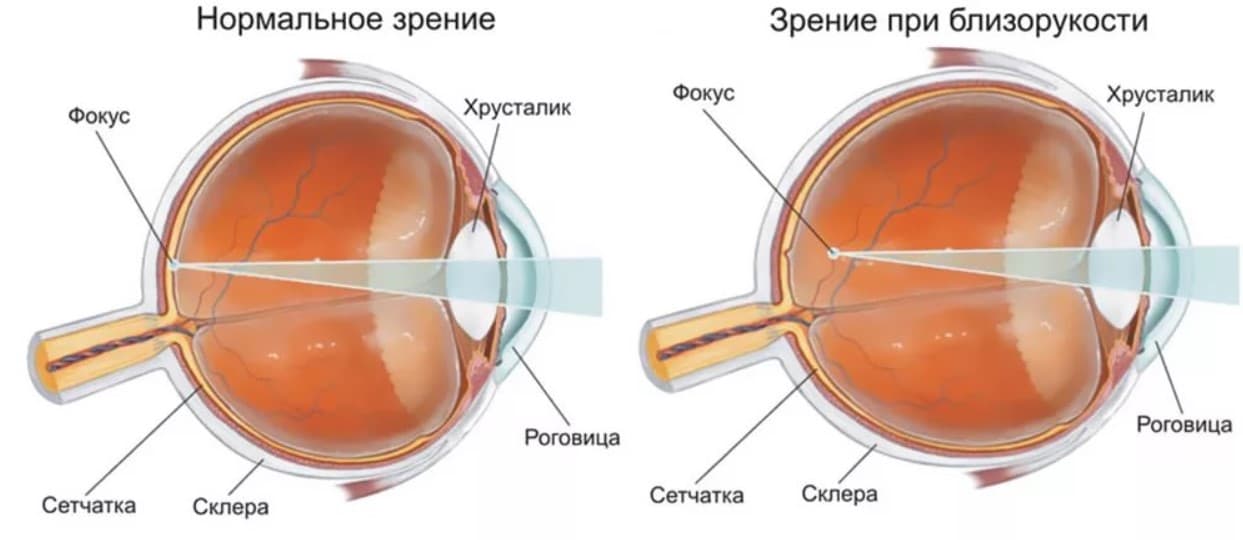 Миопия