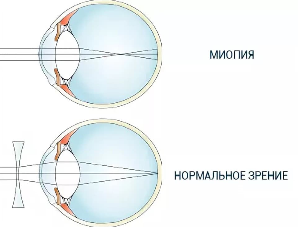 Что такое миопия высокой степени